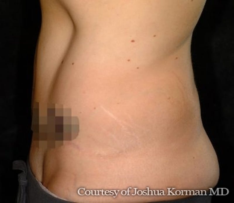 Tummy Tuck Before & After Gallery - Patient 161409 - Image 2