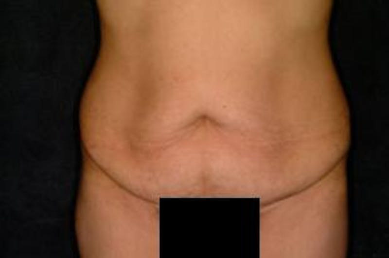 Tummy Tuck Before & After Gallery - Patient 327332 - Image 1