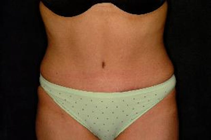 Tummy Tuck Before & After Gallery - Patient 327332 - Image 2