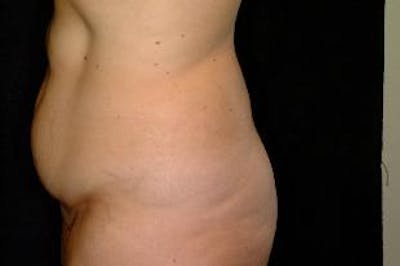 Tummy Tuck Before & After Gallery - Patient 106644 - Image 1