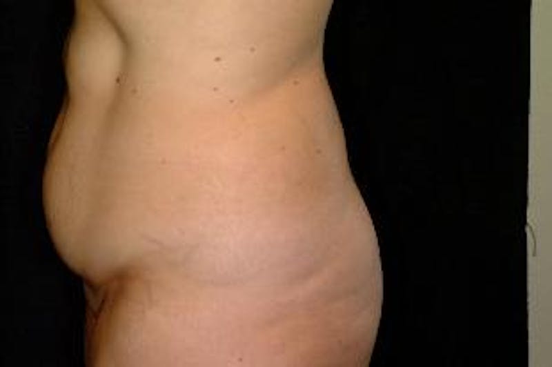 Tummy Tuck Before & After Gallery - Patient 106644 - Image 1