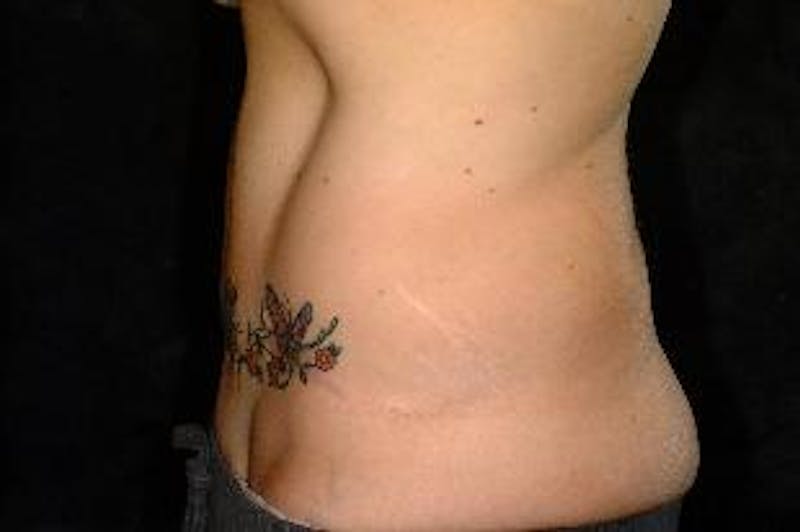 Tummy Tuck Before & After Gallery - Patient 106644 - Image 2