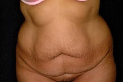 Tummy Tuck Before & After Gallery - Patient 386897 - Image 1