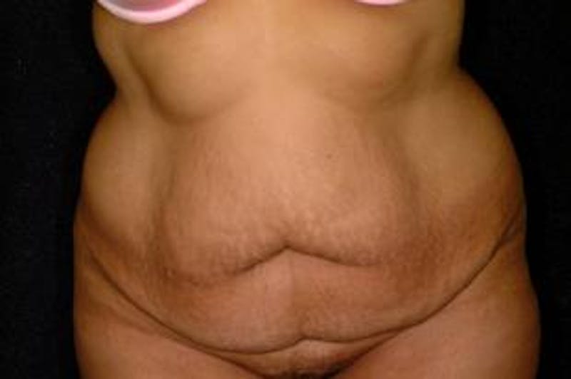 Tummy Tuck Before & After Gallery - Patient 386897 - Image 1