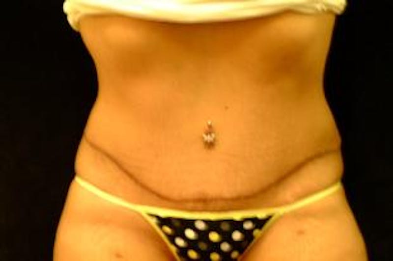 Tummy Tuck Before & After Gallery - Patient 386897 - Image 2