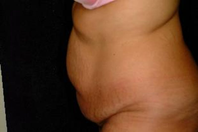 Tummy Tuck Before & After Gallery - Patient 386897 - Image 3