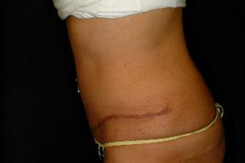 Tummy Tuck Before & After Gallery - Patient 386897 - Image 4
