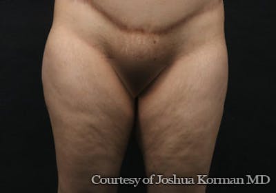 Thigh Lift Before & After Gallery - Patient 673700 - Image 1