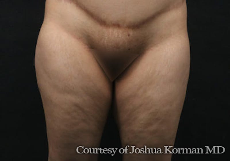 Thigh Lift Before & After Gallery - Patient 673700 - Image 1