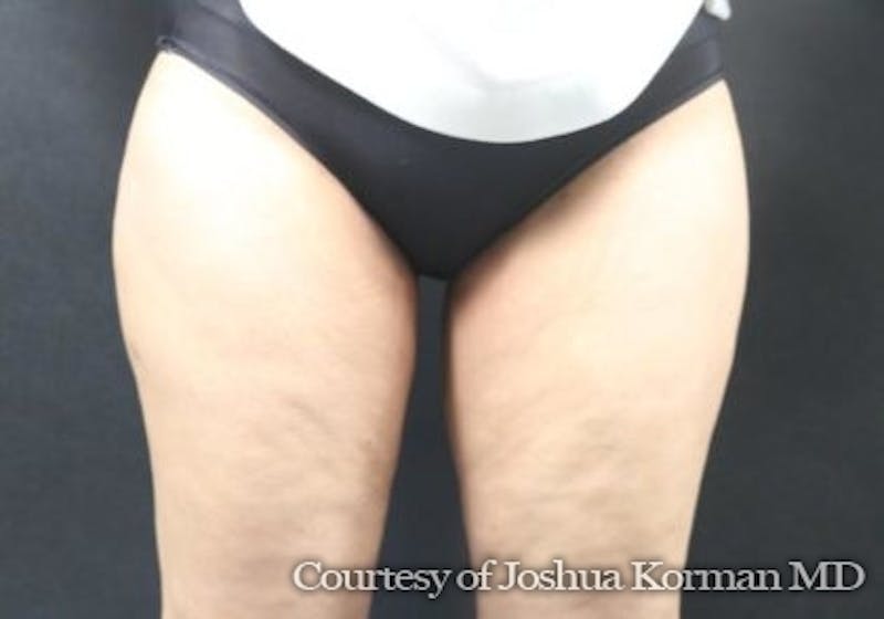 Thigh Lift Before & After Gallery - Patient 673700 - Image 2