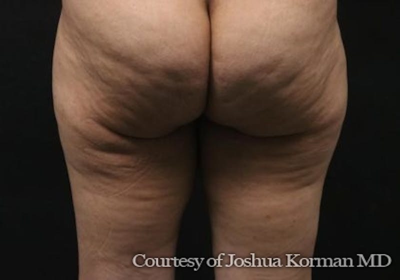 Thigh Lift Before & After Gallery - Patient 673700 - Image 3