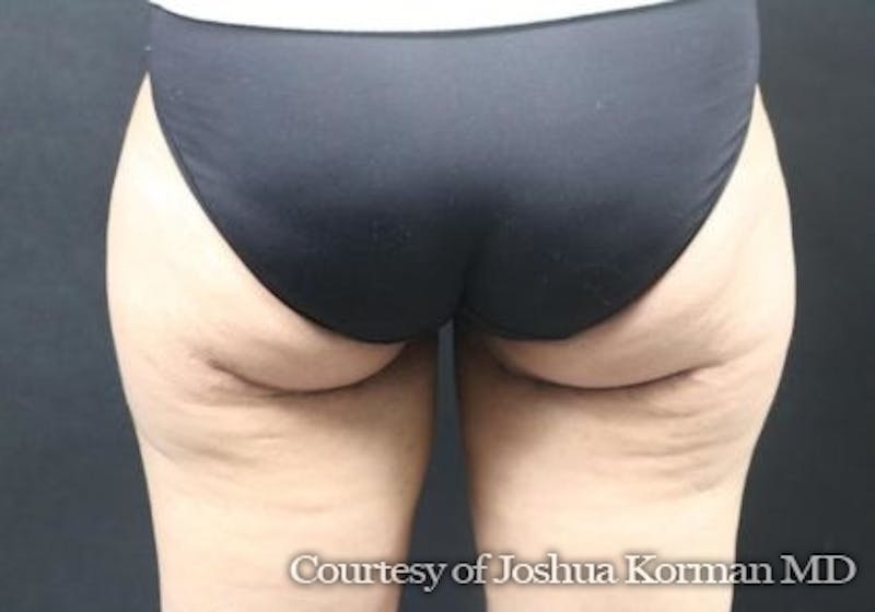 Thigh Lift Before & After Gallery - Patient 673700 - Image 4