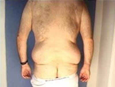 Body Lift Before & After Gallery - Patient 264901 - Image 1