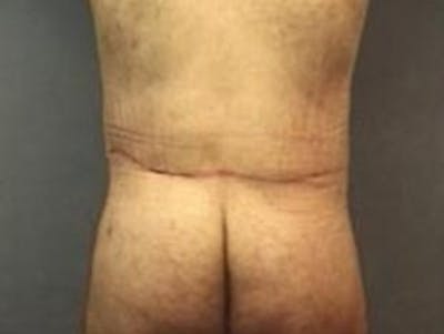 Body Lift Before & After Gallery - Patient 264901 - Image 2