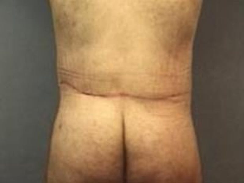 Body Lift Before & After Gallery - Patient 264901 - Image 2