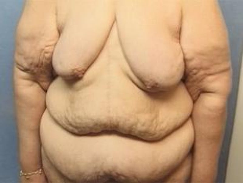 Body Lift Before & After Gallery - Patient 162476 - Image 3