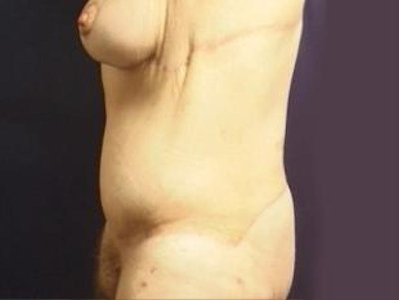 Body Lift Before & After Gallery - Patient 162476 - Image 4