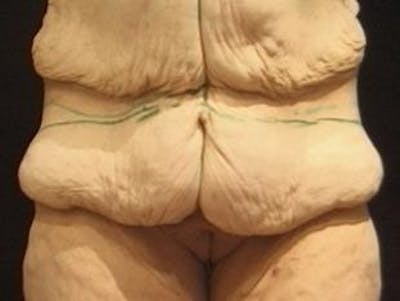 Body Lift Before & After Gallery - Patient 128704 - Image 1