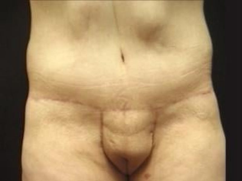 Body Lift Before & After Gallery - Patient 128704 - Image 2