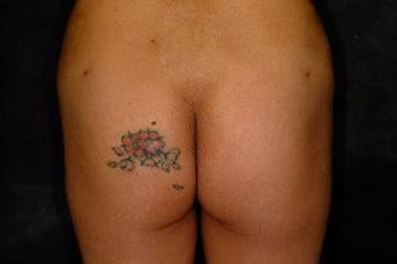 Butt Augmentation Before & After Gallery - Patient 393392 - Image 1