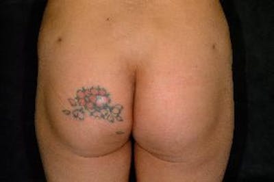 Butt Augmentation Before & After Gallery - Patient 393392 - Image 2