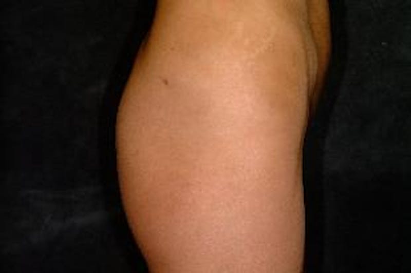 Butt Augmentation Before & After Gallery - Patient 393392 - Image 3