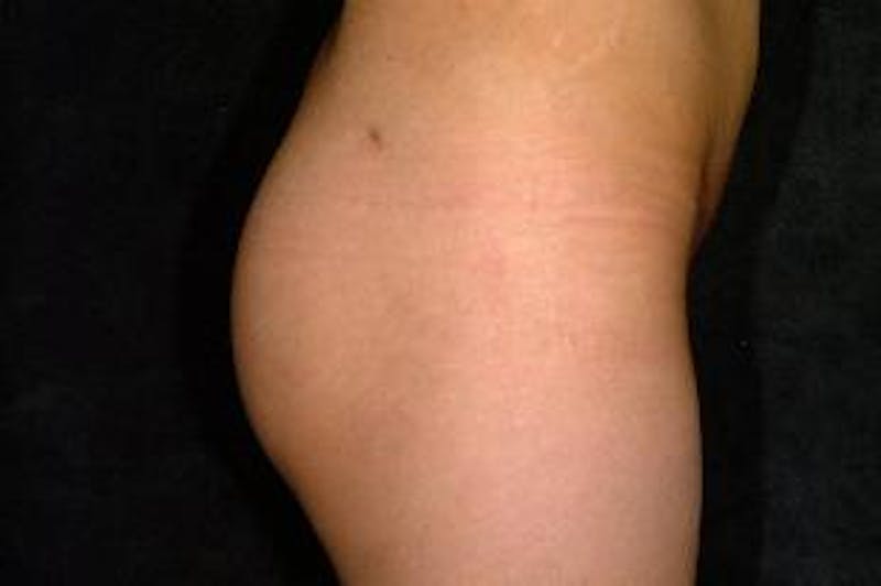 Butt Augmentation Before & After Gallery - Patient 393392 - Image 4