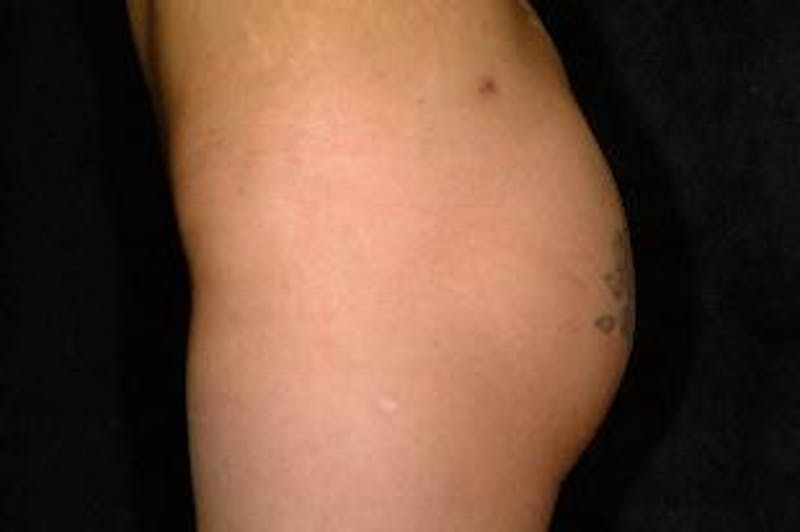 Butt Augmentation Before & After Gallery - Patient 393392 - Image 5