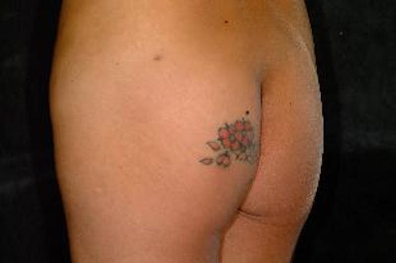 Butt Augmentation Before & After Gallery - Patient 393392 - Image 6