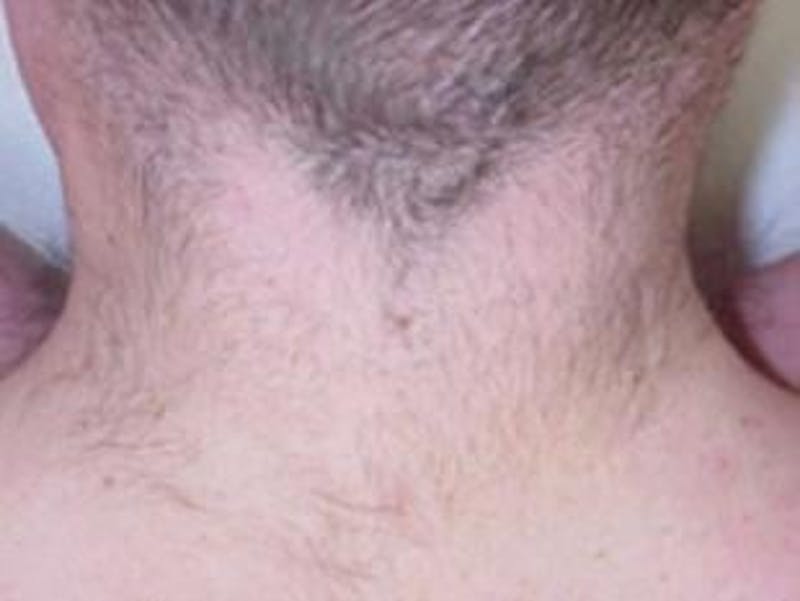 Laser Hair Removal Before & After Gallery - Patient 576940 - Image 1