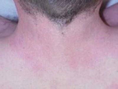 Laser Hair Removal Before & After Gallery - Patient 576940 - Image 2