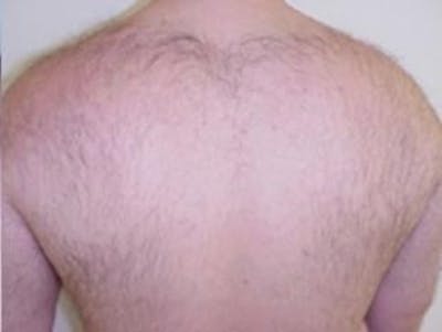 Laser Hair Removal Before & After Gallery - Patient 219252 - Image 1