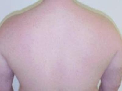 Laser Hair Removal Before & After Gallery - Patient 219252 - Image 2
