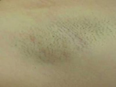 Laser Hair Removal Before & After Gallery - Patient 363202 - Image 1