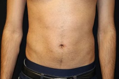 Male Liposuction Before & After Gallery - Patient 142070 - Image 2