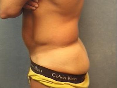Male Liposuction Before & After Gallery - Patient 224826 - Image 1