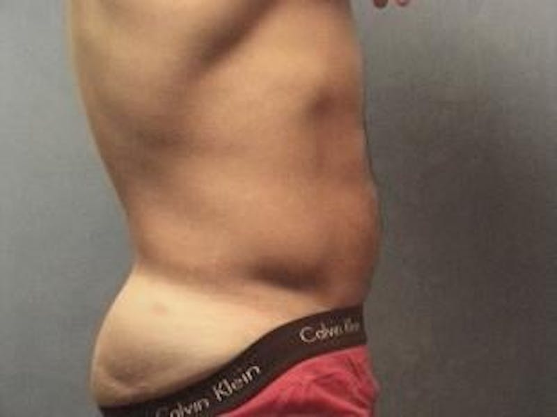 Male Liposuction Before & After Gallery - Patient 224826 - Image 4