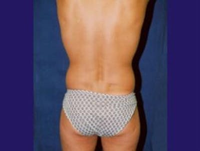 Male Liposuction Before & After Gallery - Patient 347491 - Image 1