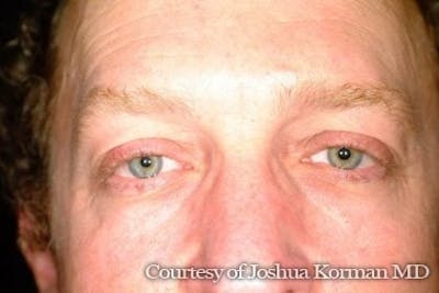 Male Eyelid Before & After Gallery - Patient 184567 - Image 1