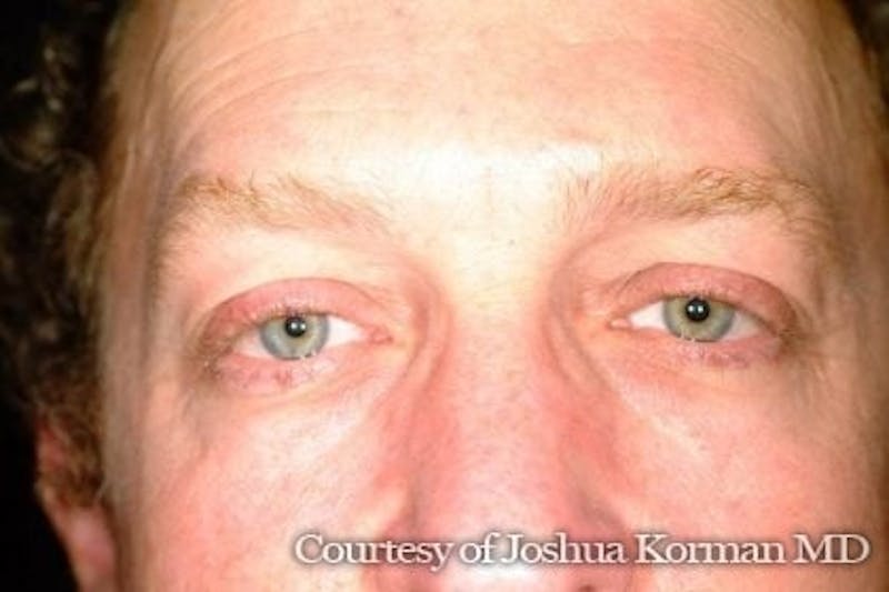Male Eyelid Before & After Gallery - Patient 184567 - Image 1