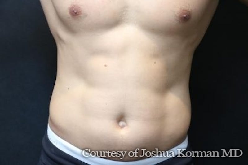 EmSculpt Neo Before & After Gallery - Patient 165435 - Image 1