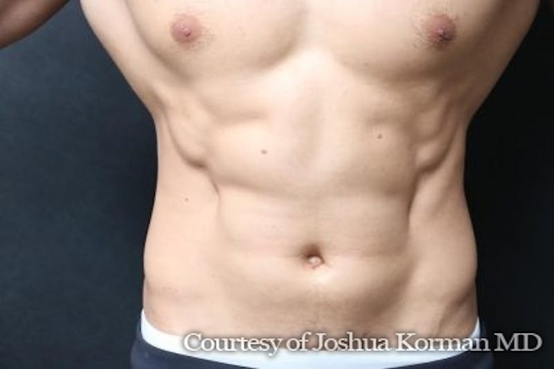 EmSculpt Neo Before & After Gallery - Patient 165435 - Image 2