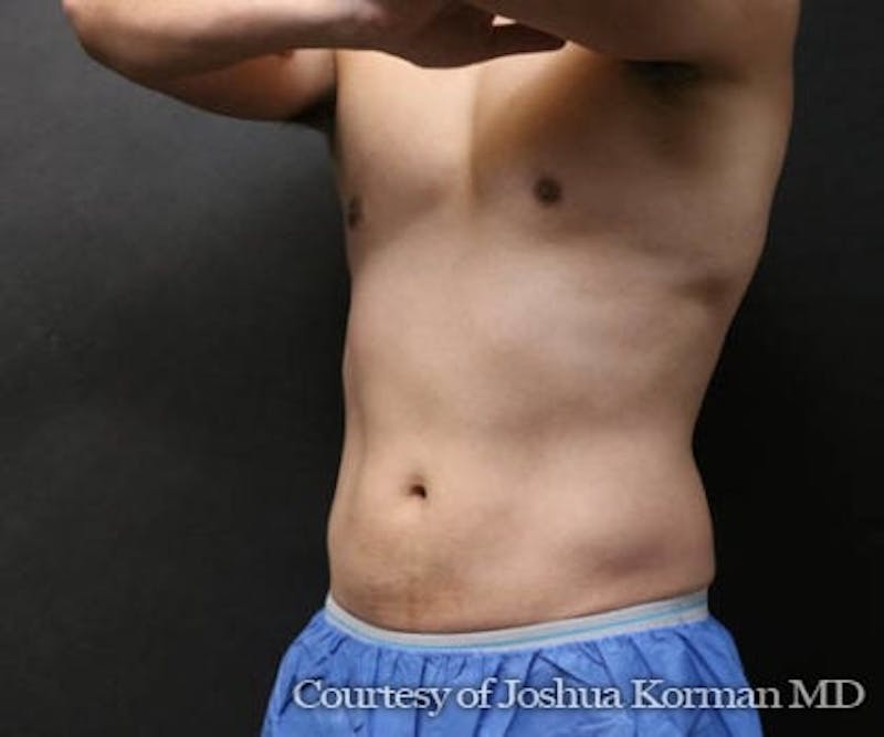 Male CoolSculpting Before & After Gallery - Patient 195374 - Image 2