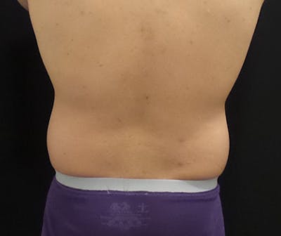 Male CoolSculpting Before & After Gallery - Patient 402070 - Image 1