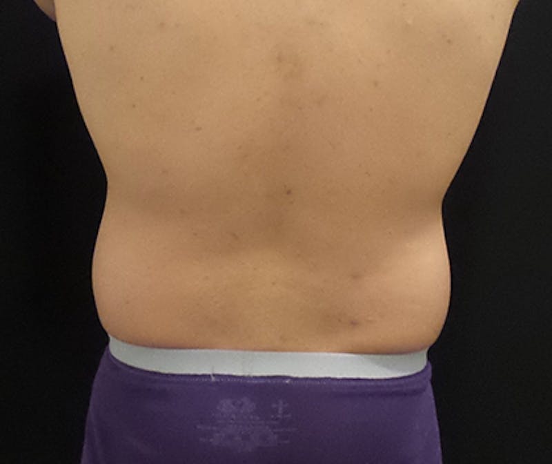 Male CoolSculpting Before & After Gallery - Patient 402070 - Image 1