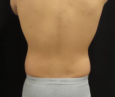 Male CoolSculpting Before & After Gallery - Patient 402070 - Image 2
