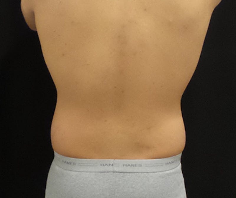 Male CoolSculpting Before & After Gallery - Patient 402070 - Image 2