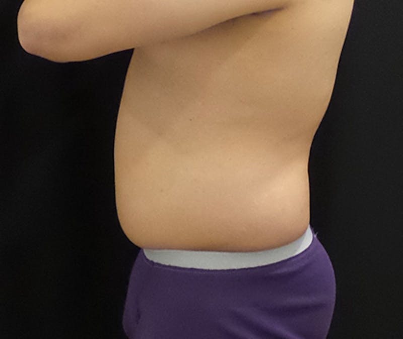 Male CoolSculpting Before & After Gallery - Patient 402070 - Image 3