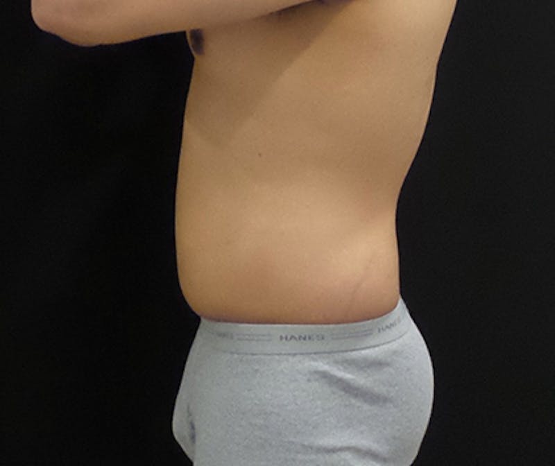 Male CoolSculpting Before & After Gallery - Patient 402070 - Image 4
