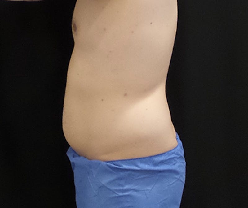 Male CoolSculpting Before & After Gallery - Patient 240570 - Image 1